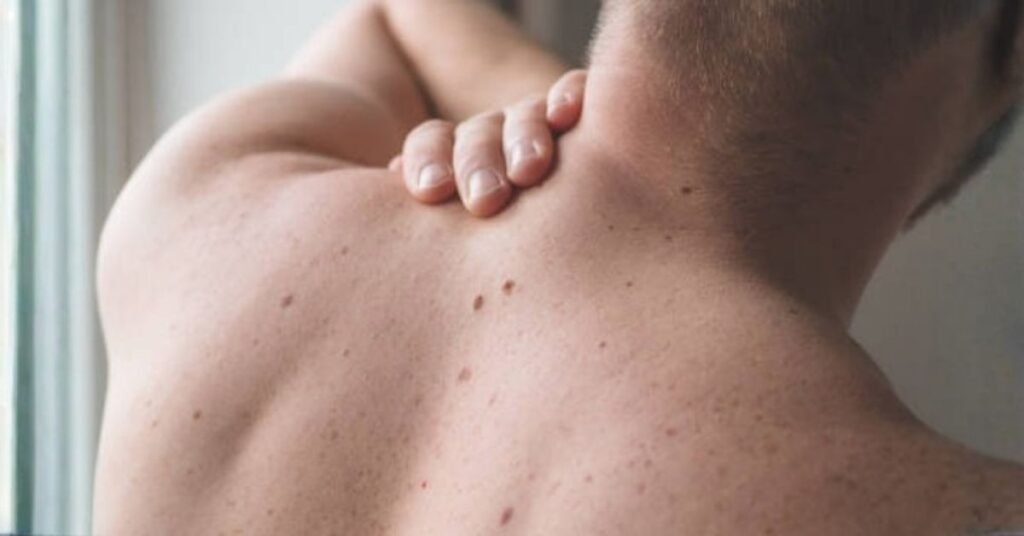 what causes skin tags