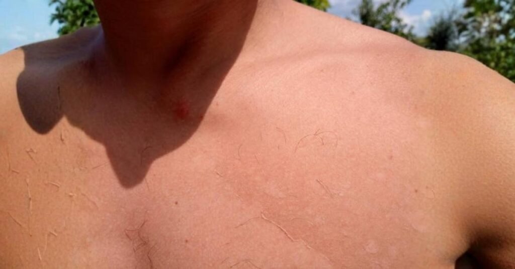 ruddy skin